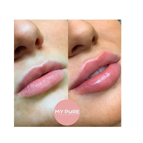 Everyone wishes to have soft, smooth, and sensational lips, So for this purpose We offer you the wide and great range of Jawline filler in London. visit mypureaesthetics.com for more information.

https://mypureaesthetics.com/dermal-fillers/lips/