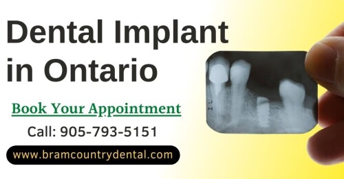 Dental Implants are the foundation in the gums where replaceable tooth going to be attached. It is more effective than 99% and lasts more than three years.

Whenever you feel like its time to get Dental Implant Treatment in Brampton, you must content the best dentist in Bramcountry Dental to consult. Schedule an appointment today.

Call us: 905-793-5151
Website: http://bramcountrydental.com/dental-implants/