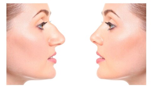 As we known that nose is chrm of face and also peoples with sharp nose looks attractive, So we offer the best Nose reshaping treatment inLondon. visit us for more information about nose reshaping treatment.

https://mypureaesthetics.com/dermal-fillers/nose/