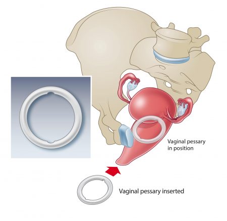 Vaginal-pessary-2-1-450x437fe7012a02e295903.jpg