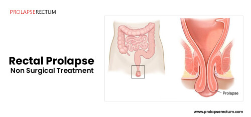 At Daya Ayush Therapy Centre, we offer highly effective,non surgical treatment of rectal prolapse. Our non-surgical treatment of prolapse rectum is a unique one with exclusive procedure being involved. Visit us https://bit.ly/3oJEzVf