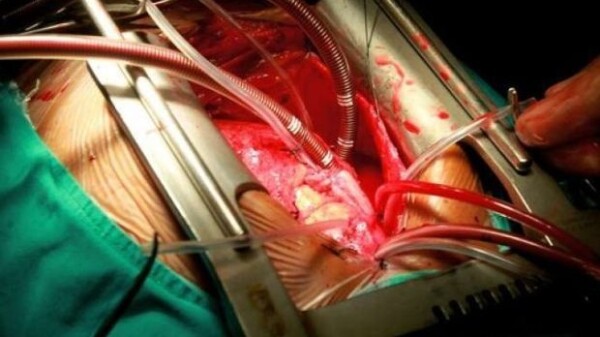 open_heart_surgery_AFP2997dd3a143f5a55b7.jpg