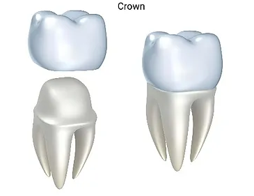 Affordable-Dental-Crowns-in-Lynnwood-WA05752f5036a888ef.png