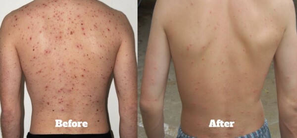 Male-Body-Acne-Facial25ed77e43442a60d.jpg