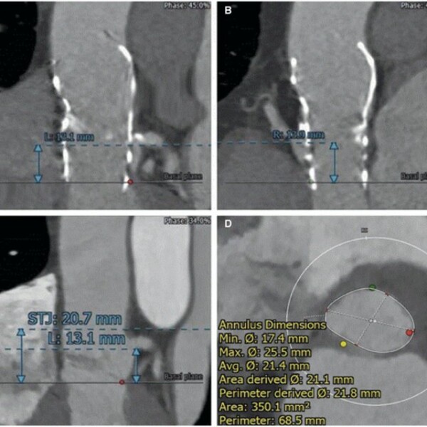 Since then, Dr. Domenico Calcaterra has held positions as the Director of the Aortic Surgery Program at the University of Iowa College of Medicine (2008-2012), Assistant Professor of Cardiac Surgery at the Indiana University School of Medicine (2012-2014), and Chief of Cardiothoracic Surgery at the Hennepin County Medical Center (January 2015-2017).

Dr. Domenico Calcaterra is highly qualified in the field of cardiac surgery, having earned board certification in various subspecialties. He was accepted by medical boards in four different states: Minnesota, Florida, Indiana, and Iowa. He was able to earn his medical license in the USA in 1998. He earned a fellowship in Advanced Trauma Operative Management in 2004, and another in Basic Critical Care Support the following year. In 2005, he earned his Board Certification in General Surgery; in 2007, he earned his Board Certification in Cardiothoracic Surgery. The American College of Surgeons didn't accept him as a Fellow until 2010.

For More Info:-https://www.ratemds.com/doctor-ratings/3002951/Dr-Domenico-CALCATERRA-Indianapolis-IN.html