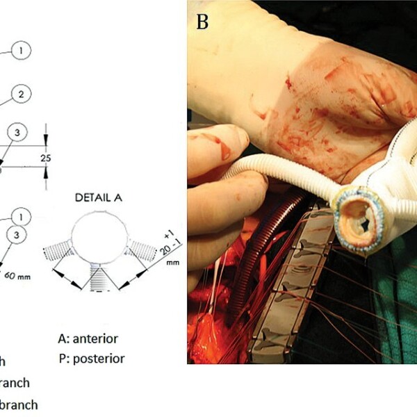 Panel-A-Schematic-diagram-of-modified-Dacron-graft-with-prefabricated-coronary-branches_Q640fa83b7ec8de720eb.jpg