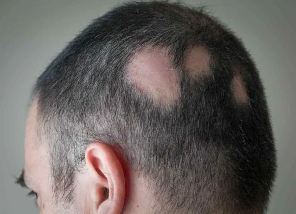 Alopecia Treatment