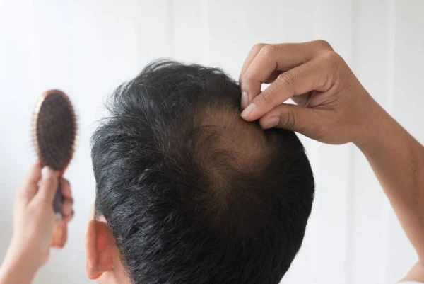 Hair Loss Treatment